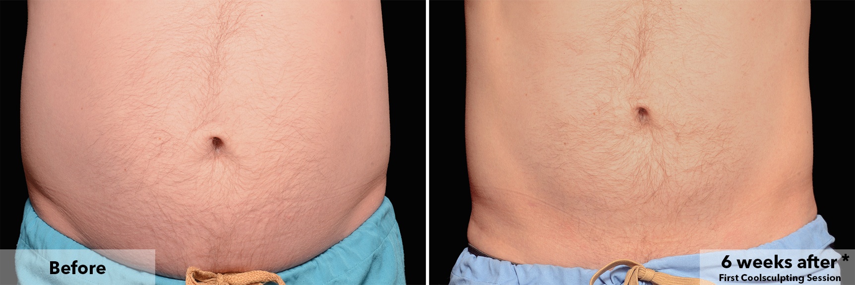 Before and After - Coolsculpting London, Cool Clinic® on Harley Street